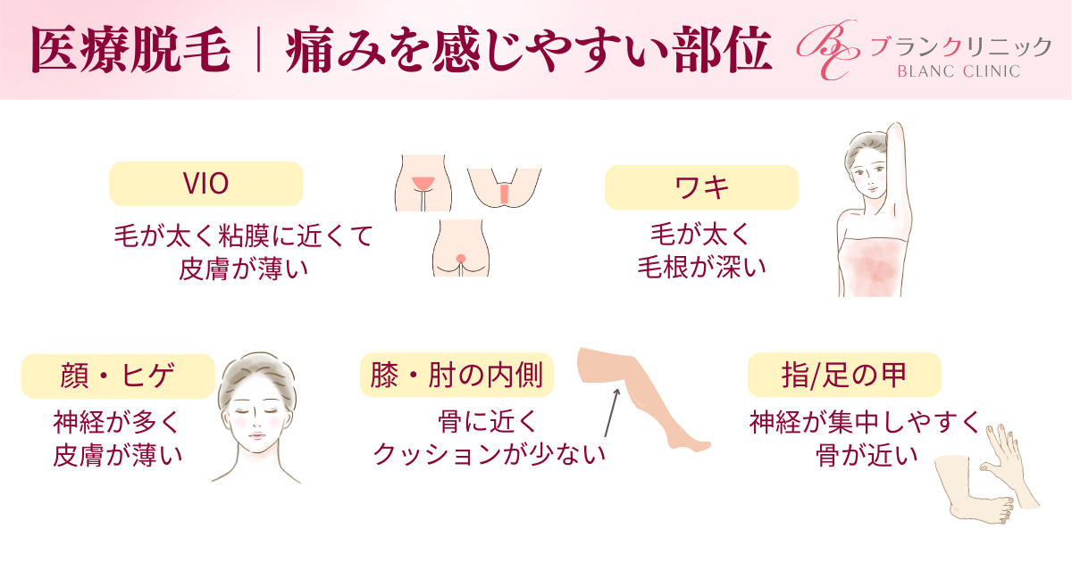 医療レーザー脱毛で痛みを感じやすい5つの部位とは