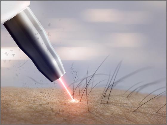 医療脱毛イメージ