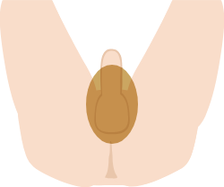 VIO脱毛（Iライン陰のう陰のう周り）